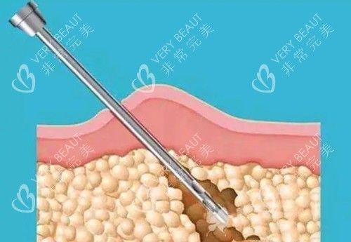 負(fù)壓吸脂卡通示意圖