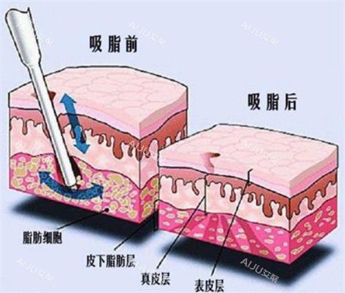 吸脂手術(shù)前后對比動畫圖示