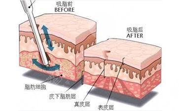 冬季快速減肥的注意事項