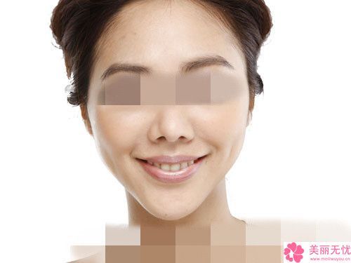舟山硅膠墊下巴手術(shù)會(huì)影響工作嗎