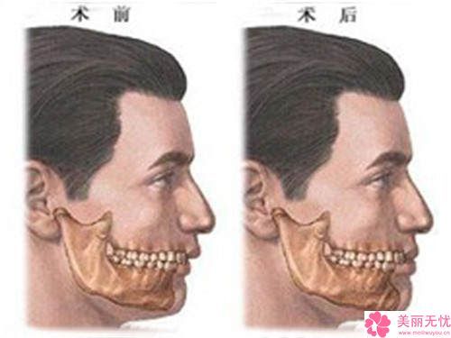 四平市第一人民医院整形美容科下颌截骨角手术手术怎么样-附整形价格表(费用)