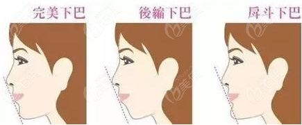 下巴整形三種手術(shù)方式