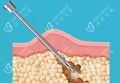 负压吸脂卡通示意图