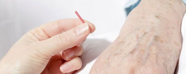 针灸减肥原理 针灸可以减肥吗 针灸减肥效果快吗