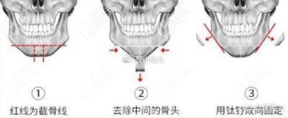 頦成型手術(shù)