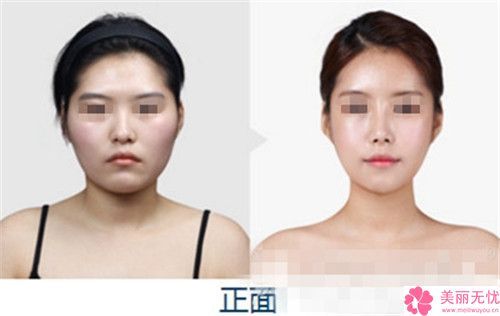 荊州李軍醫(yī)療美容診所國字臉墊下巴整形手術(shù)比較安全