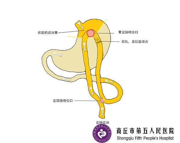做抽脂減肥手術(shù),如果以后懷孕會(huì)反彈嗎