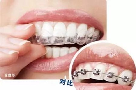 新品：整牙=換臉？隱適美IGO實(shí)現(xiàn)所有不可能！