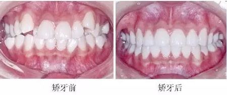 新品：整牙=換臉？隱適美IGO實(shí)現(xiàn)所有不可能！