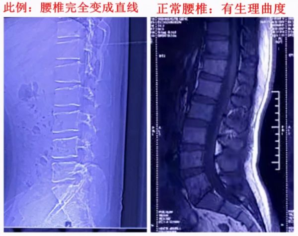“挺直腰桿”不一定是好事！腰椎生理曲度變直，該怎么辦？
