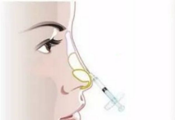 上海薇琳蔣盛林個(gè)人資料:玻尿酸隆鼻做得好附真人隆鼻實(shí)例