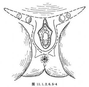 腹股溝淋巴結(jié)清掃術(shù)