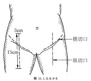 腹股溝淋巴結(jié)清掃術(shù)