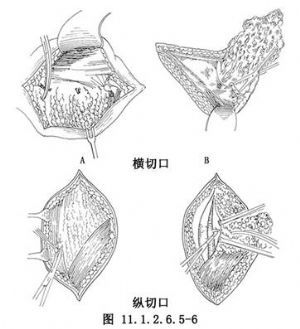 腹股溝淋巴結(jié)清掃術(shù)