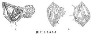 腹股溝淋巴結(jié)清掃術(shù)