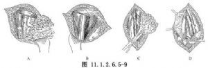 腹股溝淋巴結(jié)清掃術(shù)