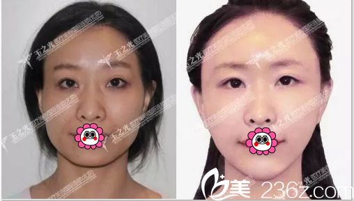 北京潤美玉之光面部脂肪填充案例