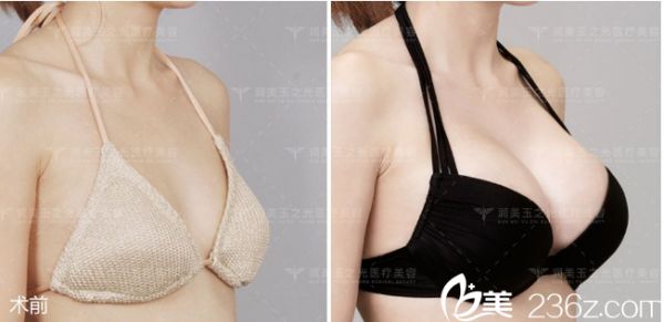 北京潤美玉之光脂肪豐胸案例