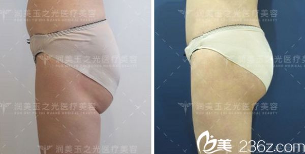 北京潤美玉之光脂肪豐臀案例