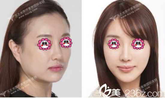 王明利面部吸脂案例