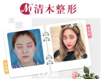 马梅生面部脂肪填充案例