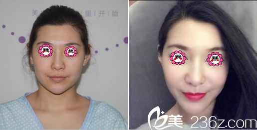 任学会腿部吸脂面部脂肪填充案例