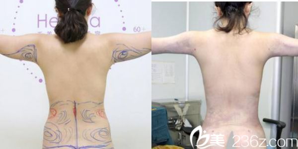 任学会腰腹吸脂和上臂吸脂案例