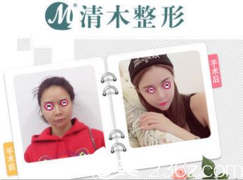 马梅生面部吸脂案例