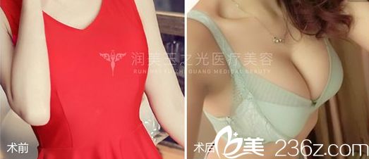 王明利腿部吸脂后脂肪丰胸案例