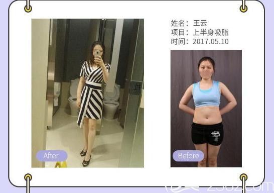 胡斌：吸脂瘦臉、瘦全身案例