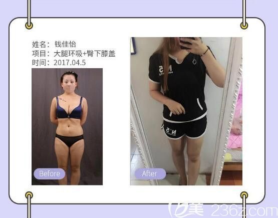 索慧珠：瘦大腿案例