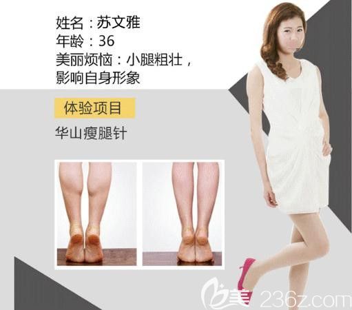 索慧珠：瘦腿案例