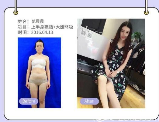 胡斌：吸脂瘦臉、瘦全身案例