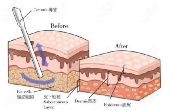潘红伟医生吸脂