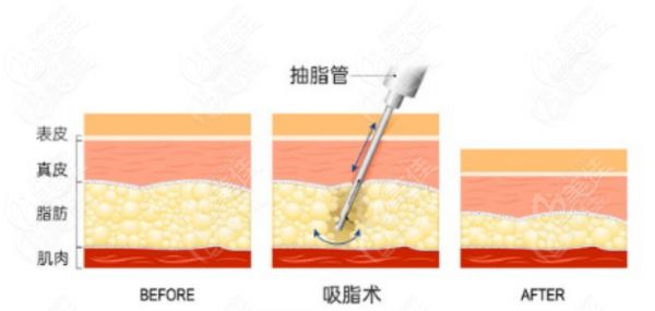 潘红伟医生抽脂