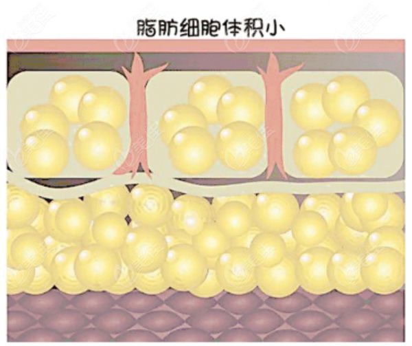 236z.com潘红伟医生吸脂示意图