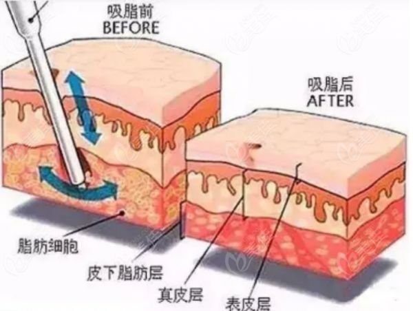 吸脂手術示意圖