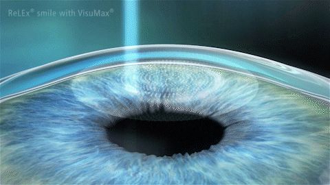 近视手术真的安全吗？术后会不会容易「反弹」？