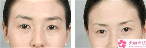吉安玻尿酸注射眉弓的優(yōu)勢及適應人群