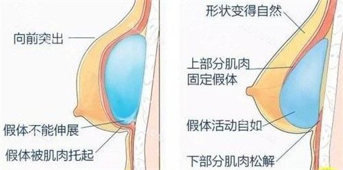 內(nèi)窺鏡隆胸