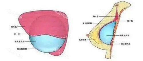 假體隆胸胸部切口卡通示意圖