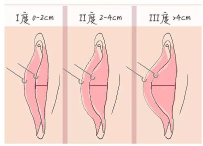 肥大困擾多？重慶軍科修復(fù)術(shù)重拾舒適生活