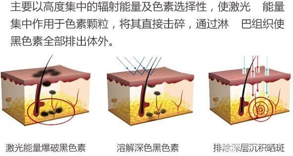 宝鸡中心医院激光美容点痣知识