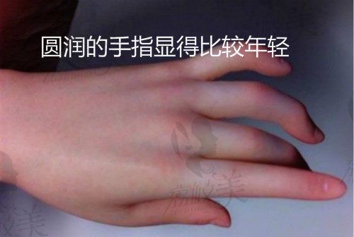 手部脂肪填充效果圖