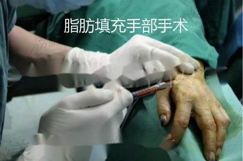 脂肪填充手部手術