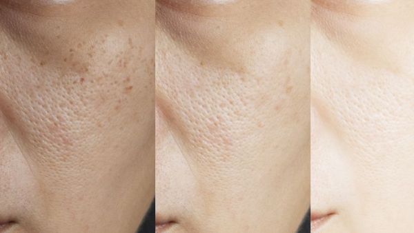 抗氧化美白针的作用