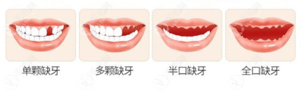 種植牙價格查詢www.59w.net
