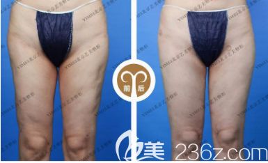 北京藝美王東醫(yī)生腿部吸脂失敗修復(fù)案例