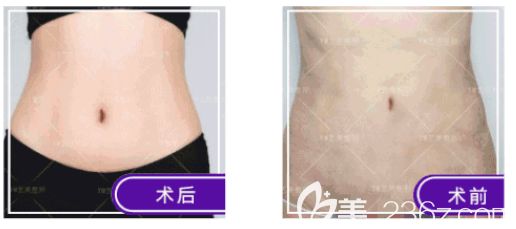 北京藝美王東醫(yī)生腰腹吸脂失敗修復(fù)案例