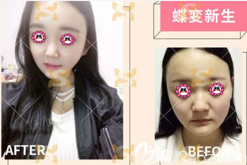 丁硯江醫(yī)生面部吸脂失敗修復(fù)案例